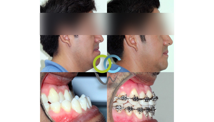 Paciente Ortoquirurgico, presentaba exceso mandibular, al cual se le realizo primero ortodoncia y después cirugia. Los resultados obtenidos son muy buenos en función y estética para el paciente.