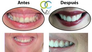 Corrección de sonrisa reduciendo encía y colocación de carillas e-max en dientes frontales.