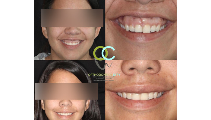 Tecnica Quirúrgica “Reposición Labial” . Quieres mejorar tu sonrisa? Te ofrecemos técnicas poco invasivas para la corrección de dichas alteraciones, con resultados altamente estéticos y satisfactorios para nuestros pacientes. 