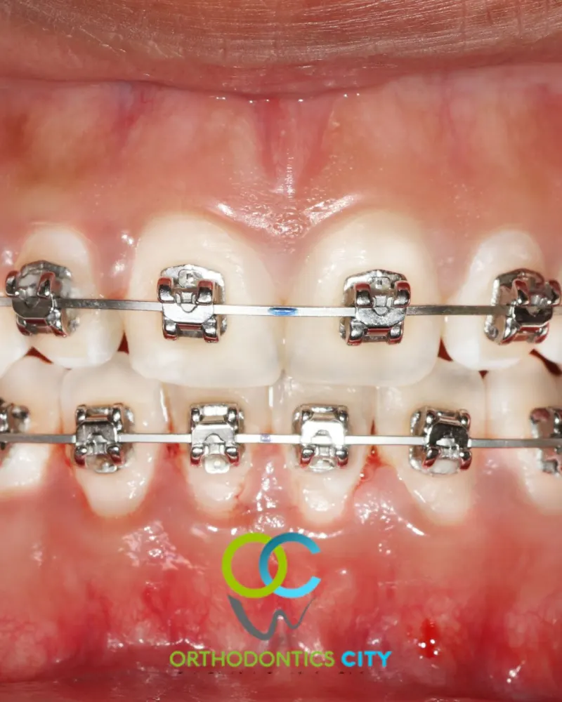 Brackets autoligados metálicos colocados en un paciente de Orthodontics City