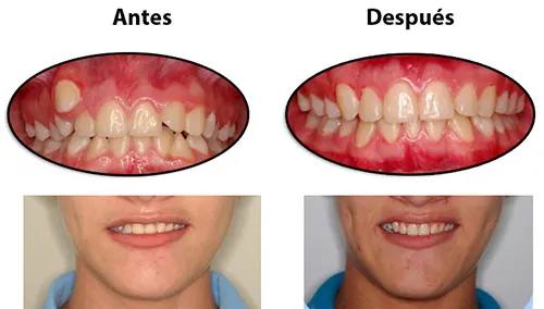 Antes y después: Canino corregido. Un canino que salió en mala posición y la falta de un incisivo inferior le daban vergüenza al sonreír. Con brackets el canino quedó en su lugar