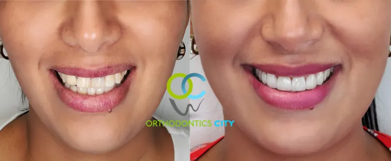 Antes y después: Caso 13: dientes con cambio de color. Dientes superiores con cambio de color y un trabajo previo poco estético, reemplazados por carillas