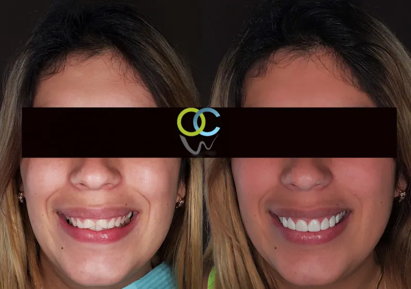 Antes y después: Caso 15: dientes desgastados. Desgaste en los dientes anteriores, resuelto con un diseño de sonrisa en resina de alta estética