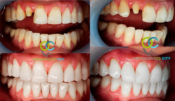 Antes y después: Corona en un lateral. Un diente restaurado para igualar la sonrisa
