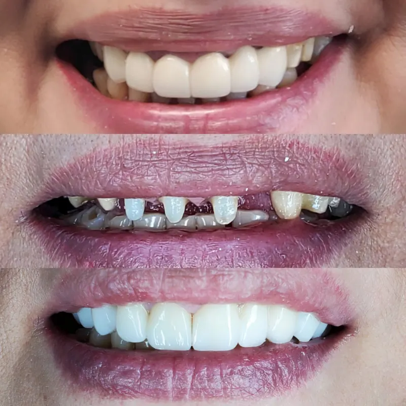 Antes y después: Caso 18: paciente del extranjero. Llegó con un puente en muy malas condiciones. Hicimos un puente de porcelana con buen sellado y acabado