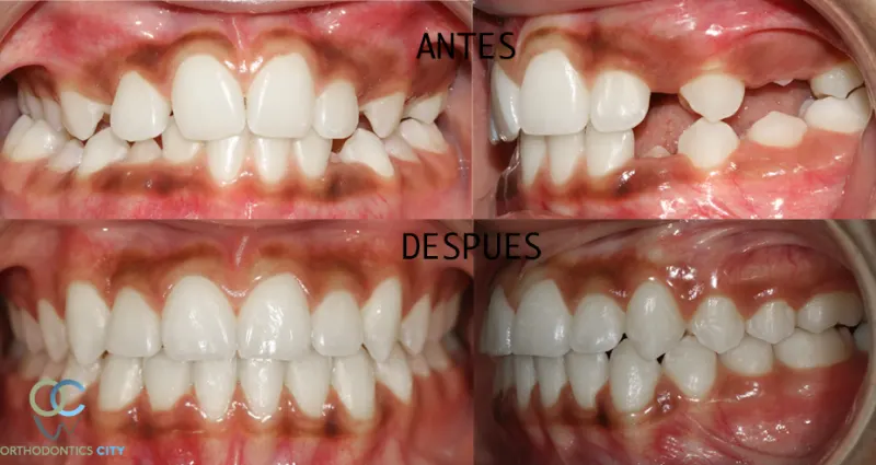 Antes y después: Diseño de sonrisa con ortodoncia. Dientes alineados con ortodoncia como base del diseño de la sonrisa