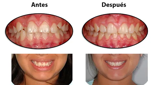 Antes y después: Diente lateral corregido. Un diente lateral estaba por dentro de los demás (cruzado). Con brackets se alineó y la sonrisa ganó armonía