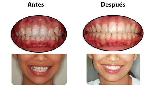 Antes y después: Línea media centrada. Sonrisa corregida sin extracciones: se ordenaron los dientes y se centró la línea media