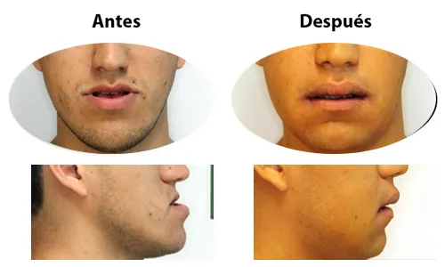 Antes y después: Mandíbula y perfil. Corrección de la posición de la mandíbula y del perfil