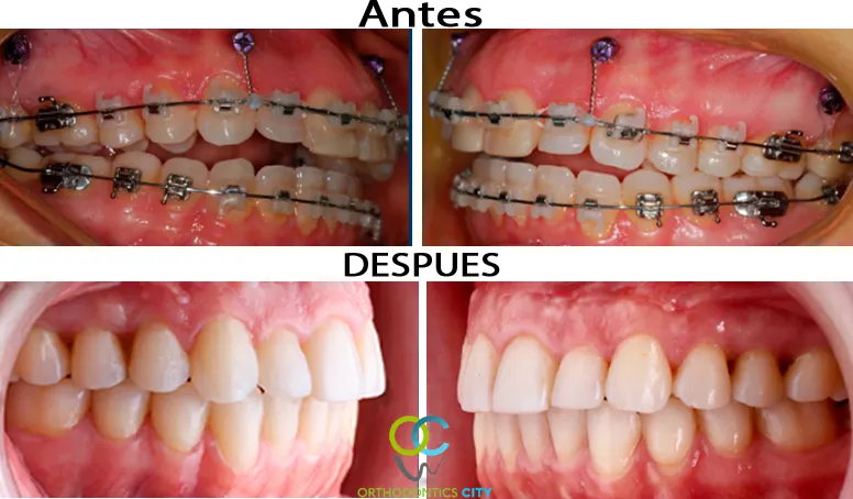 Antes y después: Mordida abierta cerrada con miniimplantes. Miniimplantes de ortodoncia en la zona anterior y posterior superior para corregir la sonrisa gingival y cerrar la mordida abierta