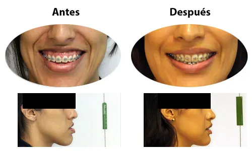 Antes y después: Corrigiendo el perfil. Cambio del perfil al terminar el tratamiento de ortodoncia