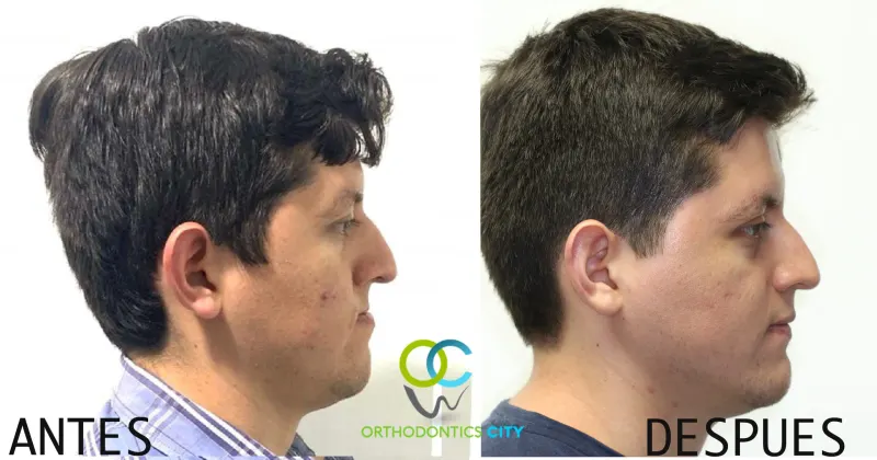 Antes y después: Cambio del perfil facial. Vista lateral del paciente antes y después del tratamiento