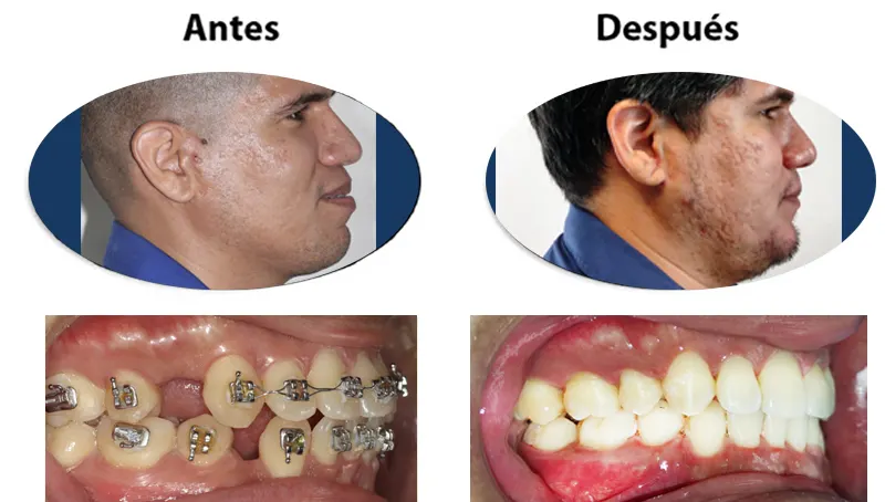 Antes y después: Perfil corregido sin cirugía. Corrección del perfil solo con ortodoncia, sin cirugía ortognática