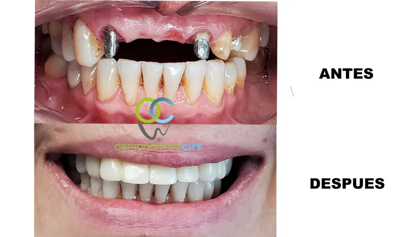 Antes y después: Caso 17: puente anterior de porcelana. El paciente llegó con un puente en malas condiciones. Confeccionamos un nuevo puente anterosuperior de porcelana