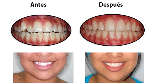 Antes y después: Corrigiendo la sonrisa. Mordida corregida con brackets. Al retirarlos, la paciente vio por fin su nueva sonrisa
