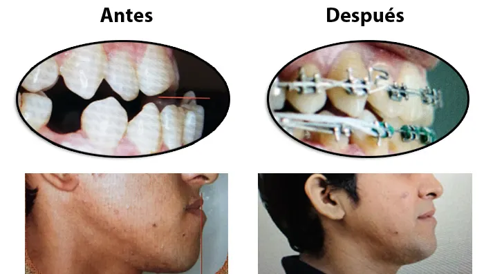 Antes y después de ortodoncia: sonrisa y perfil corregidos