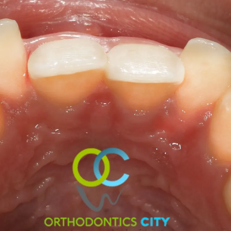 Antes y después: Apiñamiento. Dientes encimados alineados con brackets