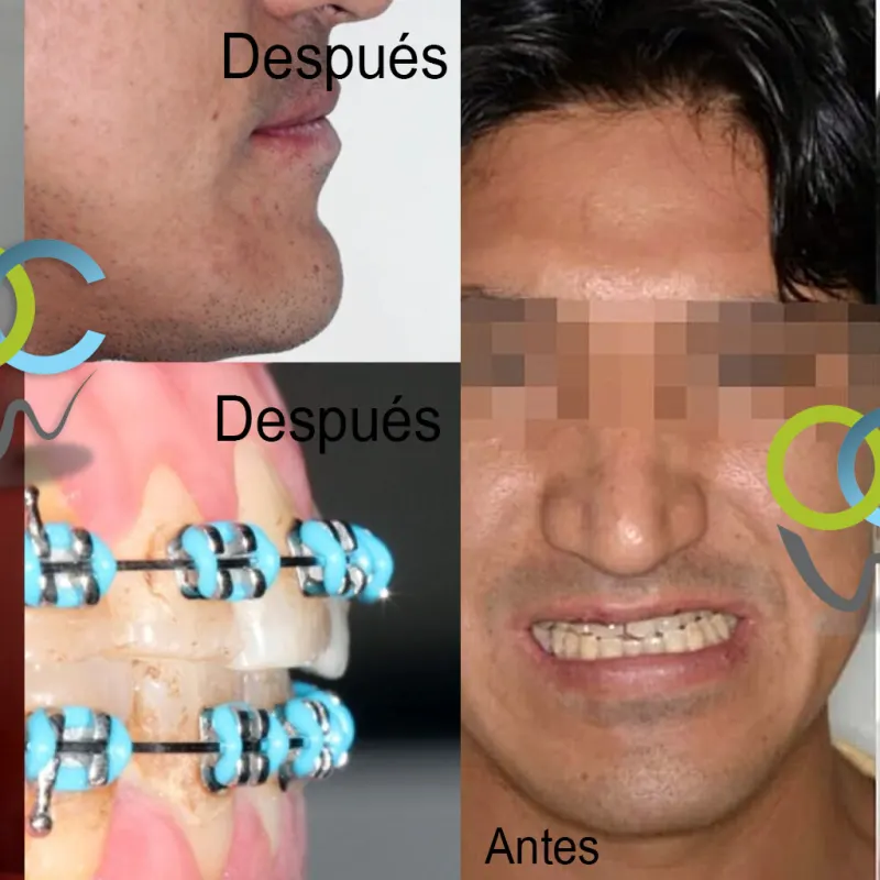 Antes y después: Asimetría facial. Corrección con cirugía ortognática