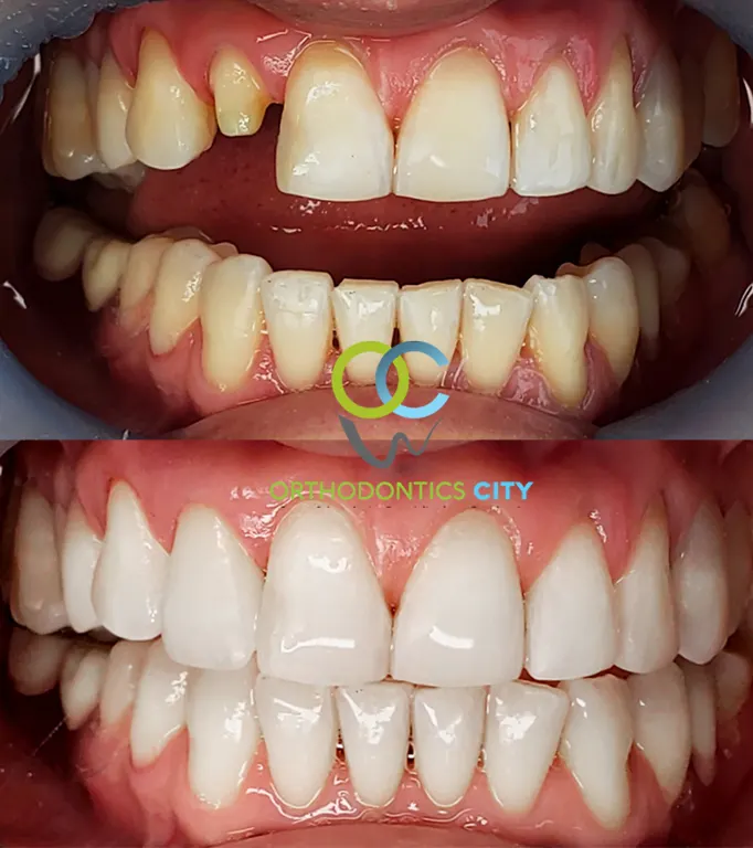 Antes y después de carillas dentales en un paciente de Orthodontics City