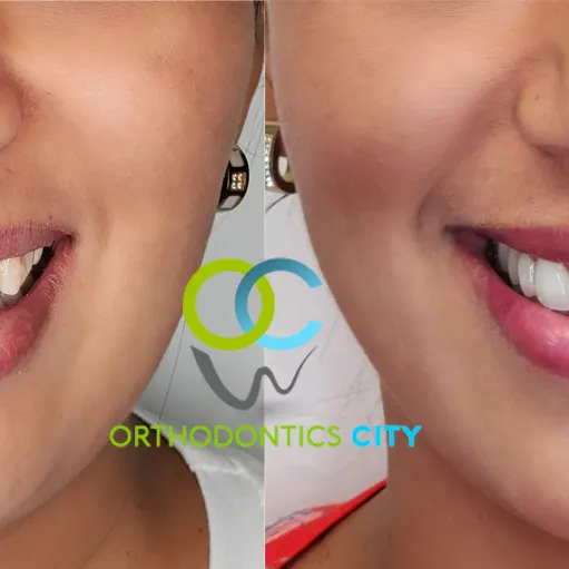 Antes y después: Carillas dentales. Forma y color renovados con carillas