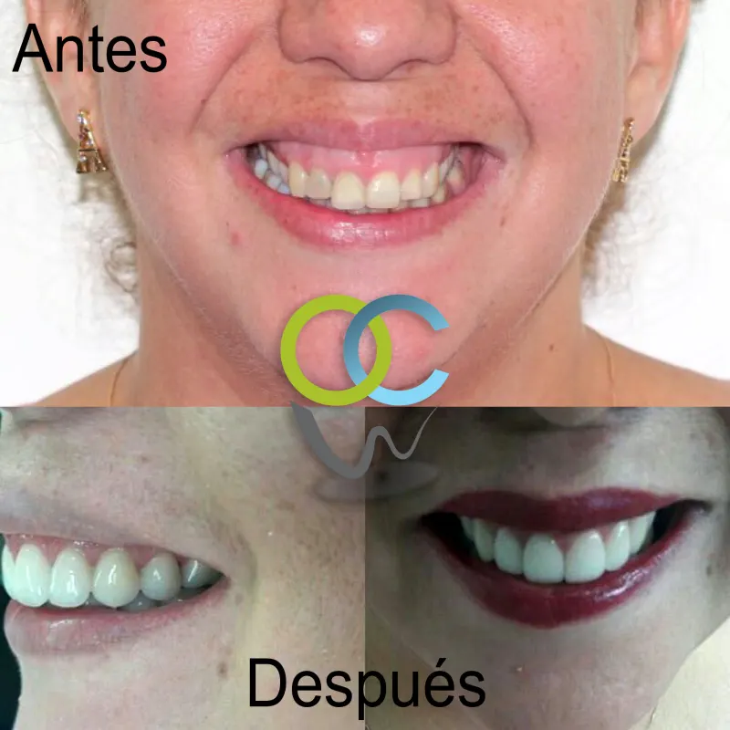 Antes y después: Carillas y reposición labial. Sonrisa gingival resuelta con reposición labial, gingivectomía y carillas e-max