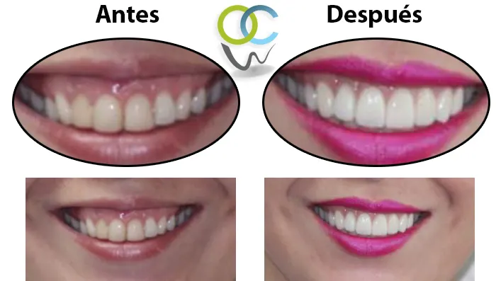 Antes y después: Carillas de porcelana. Color y forma renovados