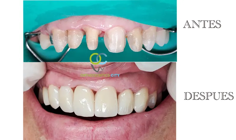 Antes y después: Coronas. Dientes desgastados restaurados con coronas