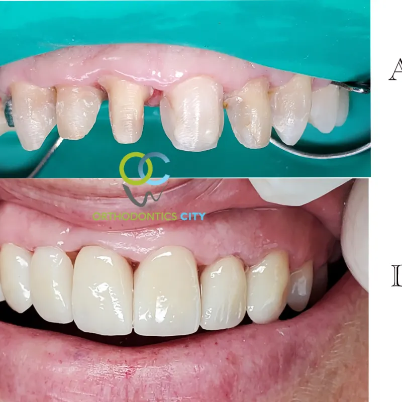Antes y después: Coronas. Dientes desgastados restaurados