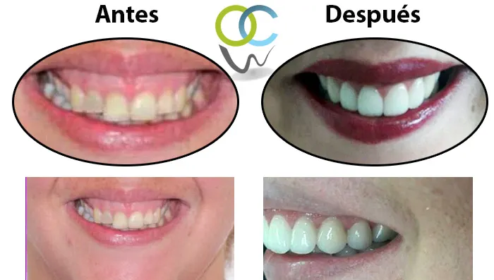 Antes y después: Encía y carillas. Reducción de encía y carillas e-max