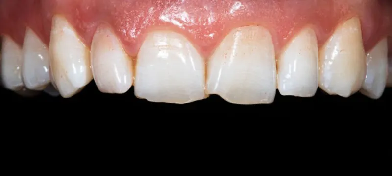Antes y después: Antes. Bordes fracturados y desgastados en los dientes de adelante