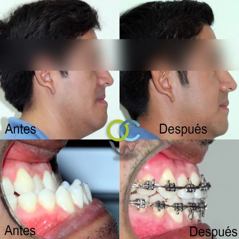 Antes y después: Exceso mandibular. Ortodoncia y cirugía para corregir función y estética