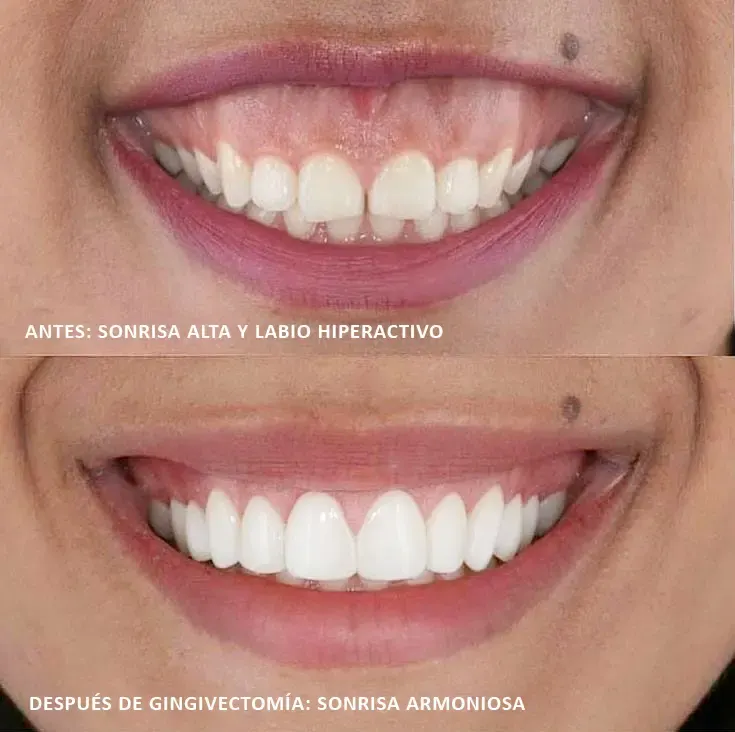 Sonrisa con exceso de encía antes y encías contorneadas después de una gingivectomía