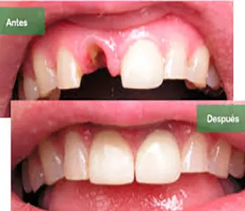Antes y después: Implante dental. Sonrisa y masticación recuperadas con un implante
