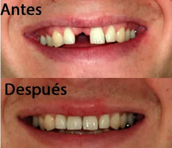 Antes y después: Confianza de vuelta. Implantes para recuperar la sonrisa tras perder dientes