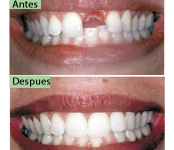 Antes y después: Puente fijo sobre implantes