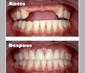 Antes y después: Varios dientes ausentes. Sector anterior rehabilitado sobre implantes