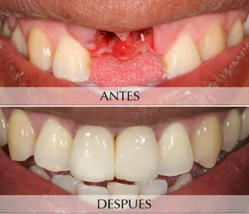 Antes y después: Reemplazo de molar. Molar perdido reemplazado con un implante