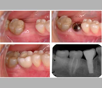 Antes y después: Molar posterior. Implante y corona en un molar, con control radiográfico