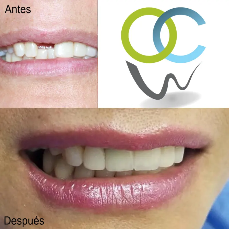 Antes y después: Diente anterior perdido. Espacio en la sonrisa resuelto con implante y corona