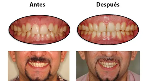 Antes y después: Mordida corregida. Mordida corregida con ortodoncia