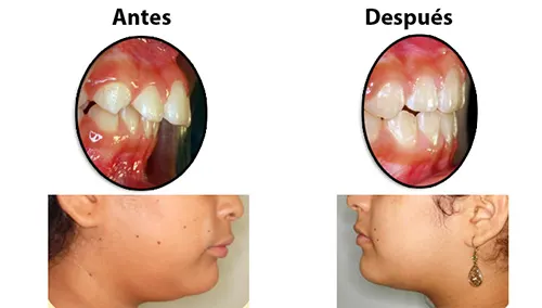 Antes y después: Dientes hacia afuera. Overjet marcado corregido con exodoncias; perfil recto