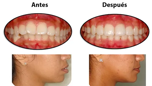 Antes y después: Mejor perfil facial. Perfil y sonrisa mejorados con extracciones y ortodoncia