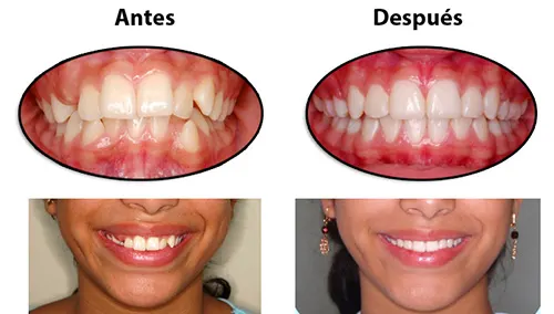 Antes y después: Una sonrisa nueva. Corrección con extracciones y brackets