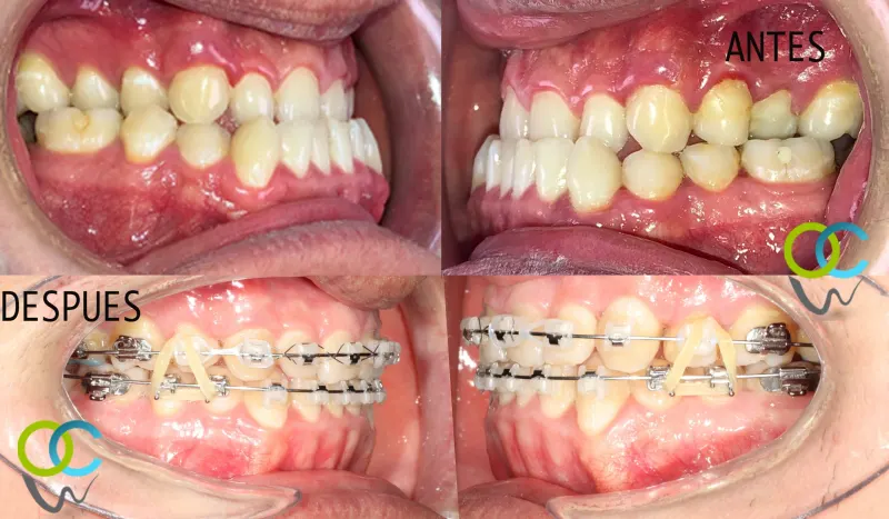 Antes y después: Mordida corregida. Ortodoncia y cirugía para que los dientes encajen