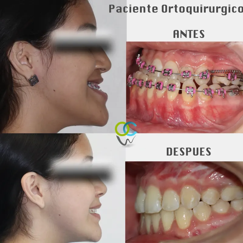 Antes y después: Paciente ortoquirúrgico clase III. Tercio medio hundido y mandíbula adelantada: brackets para preparar la cirugía ortognática y luego la cirugía