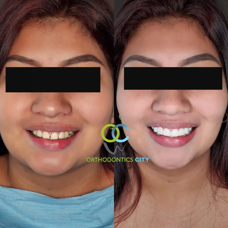 Paciente antes y después de una rehabilitación oral, con una sonrisa completa y armónica