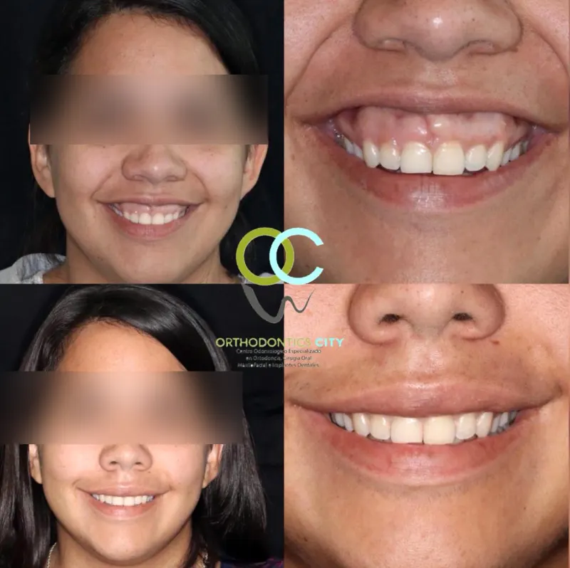 Antes y después: Reposición labial. Técnica quirúrgica poco invasiva para la sonrisa gingival
