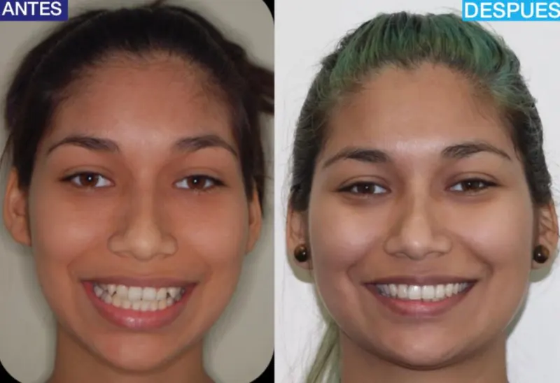 Antes y después: Caso 1: sonrisa alineada. Fotos de frente al inicio y al final del tratamiento de ortodoncia. Su video testimonio está más abajo en esta página