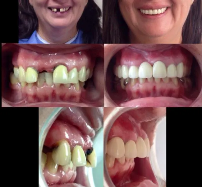 Antes y después: Caso 9: paciente que viajó desde EE. UU.. Le resultaba muy costoso tratarse allá. Con un solo plan hicimos tratamientos de conducto, coronas de porcelana, carillas e implante dental en poco tiempo