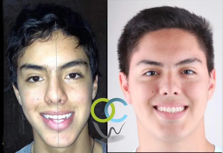 Antes y después: Caso 4: mordida clase III. Con extracción de segundos molares inferiores mejoramos su perfil y logramos guías caninas y molares clase I